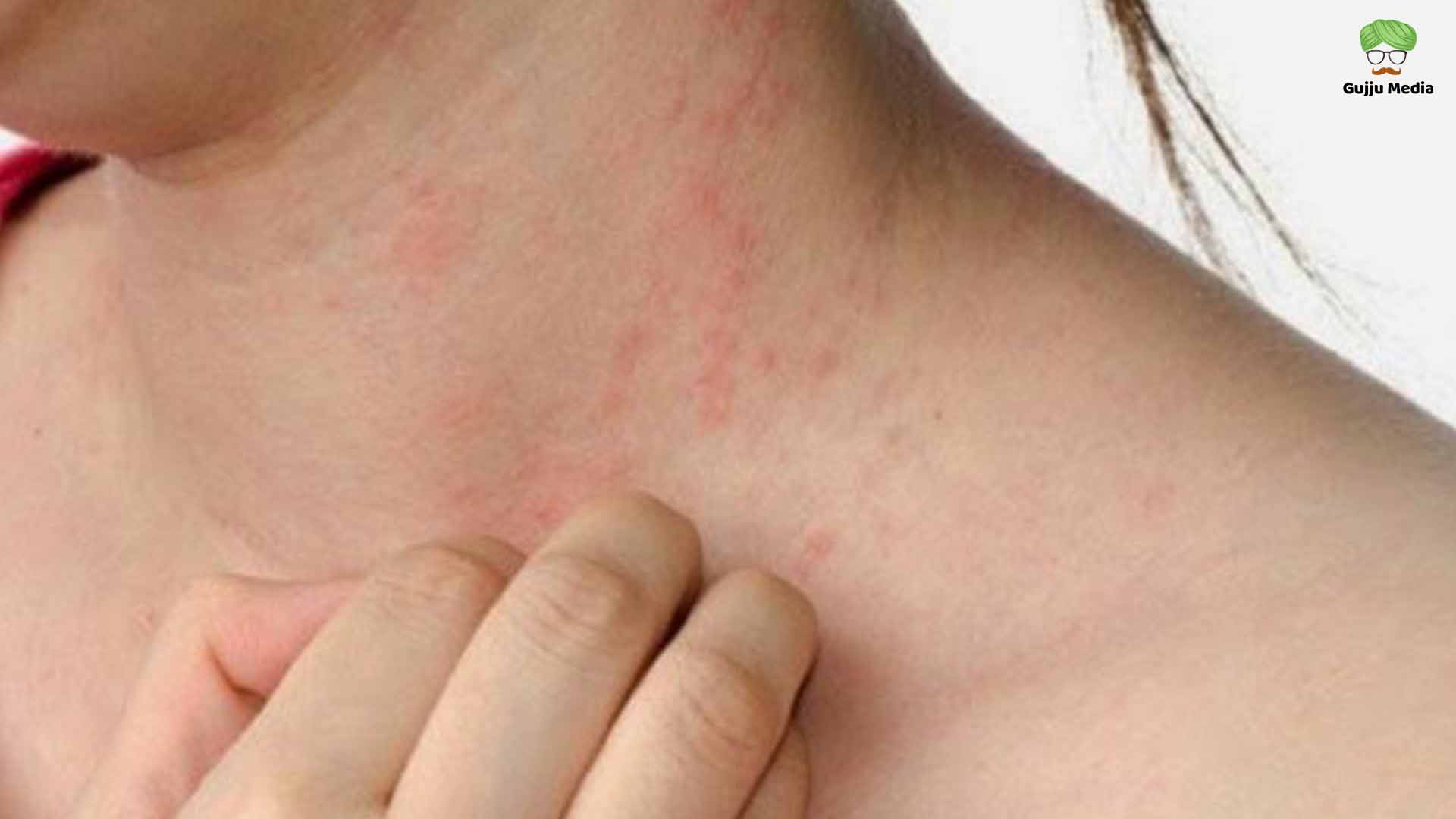 એક્ઝિમા eczema