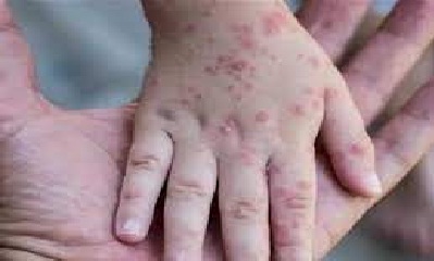 A five-year-old girl in Ghaziabad, UP, showed symptoms of monkey pox