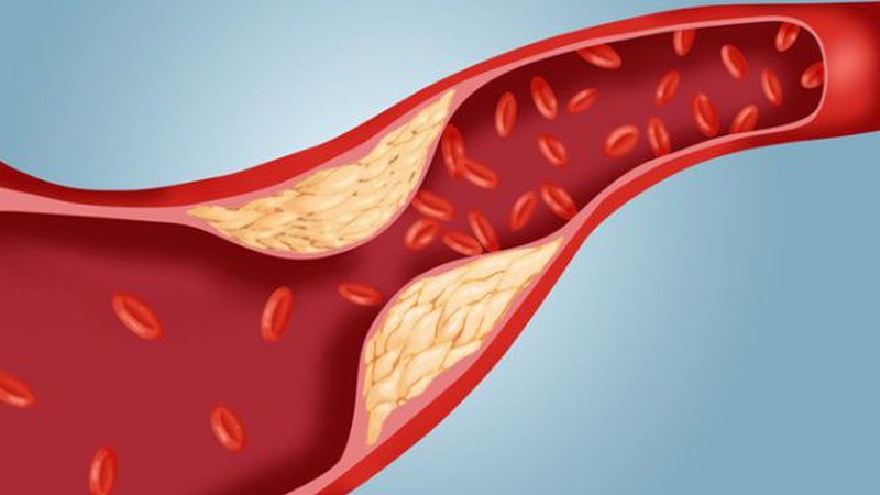 If these symptoms appear in the body, be careful! May be high cholesterol