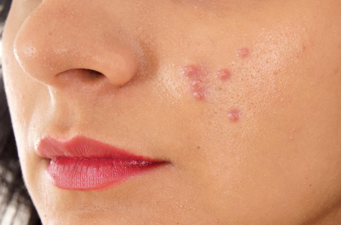 Follow this easy way to get rid of pimples and blemishes on the face!