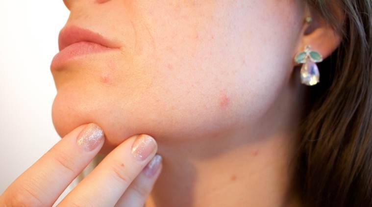 Follow this easy way to get rid of pimples and blemishes on the face!