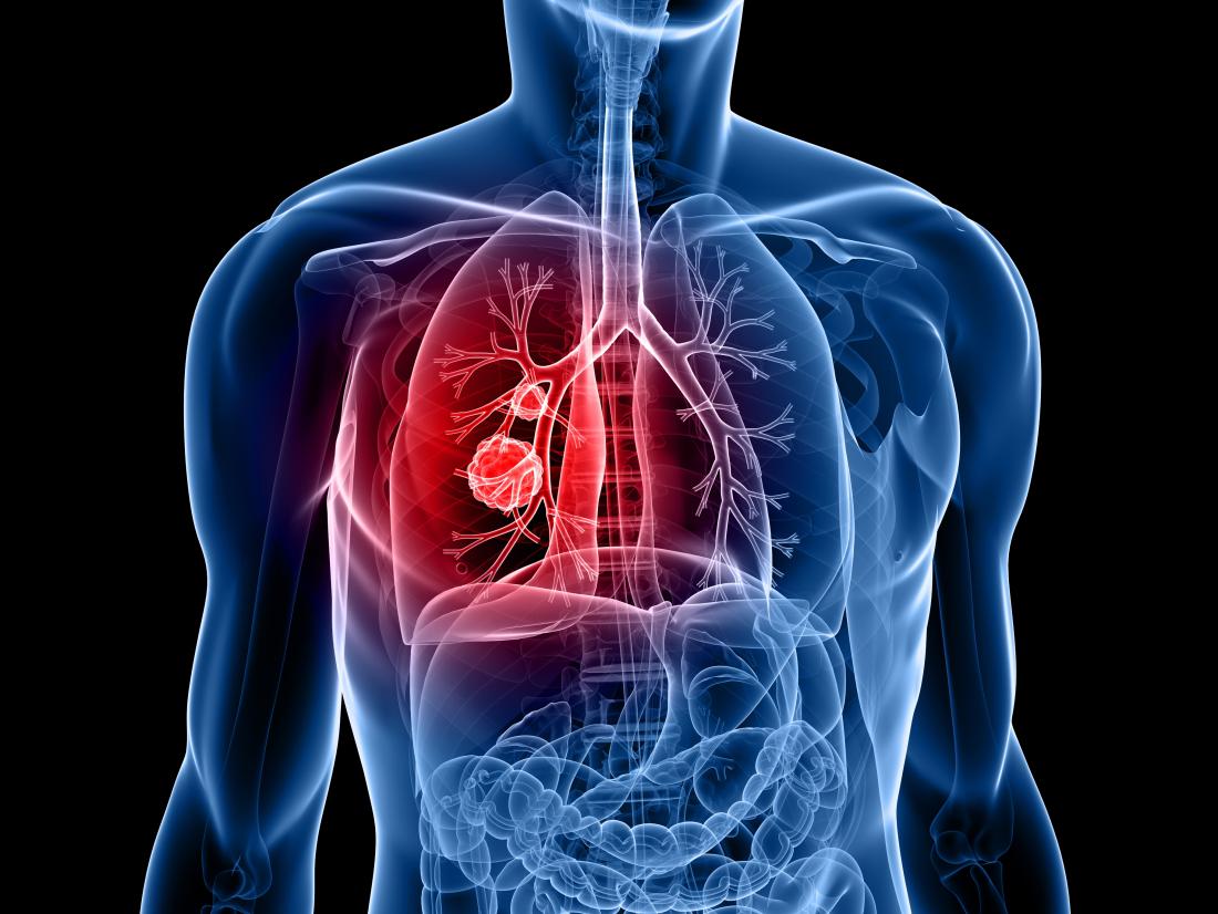 World Lung Cancer Day 2023: માત્ર ધૂમ્રપાન જ નહીં, આ વસ્તુઓ ફેફસાંને પણ ખરાબ રીતે નુકસાન પહોંચાડી શકે છે 2 World Lung Cancer Day 2023 માત્ર ધૂમ્રપાન જ નહીં આ