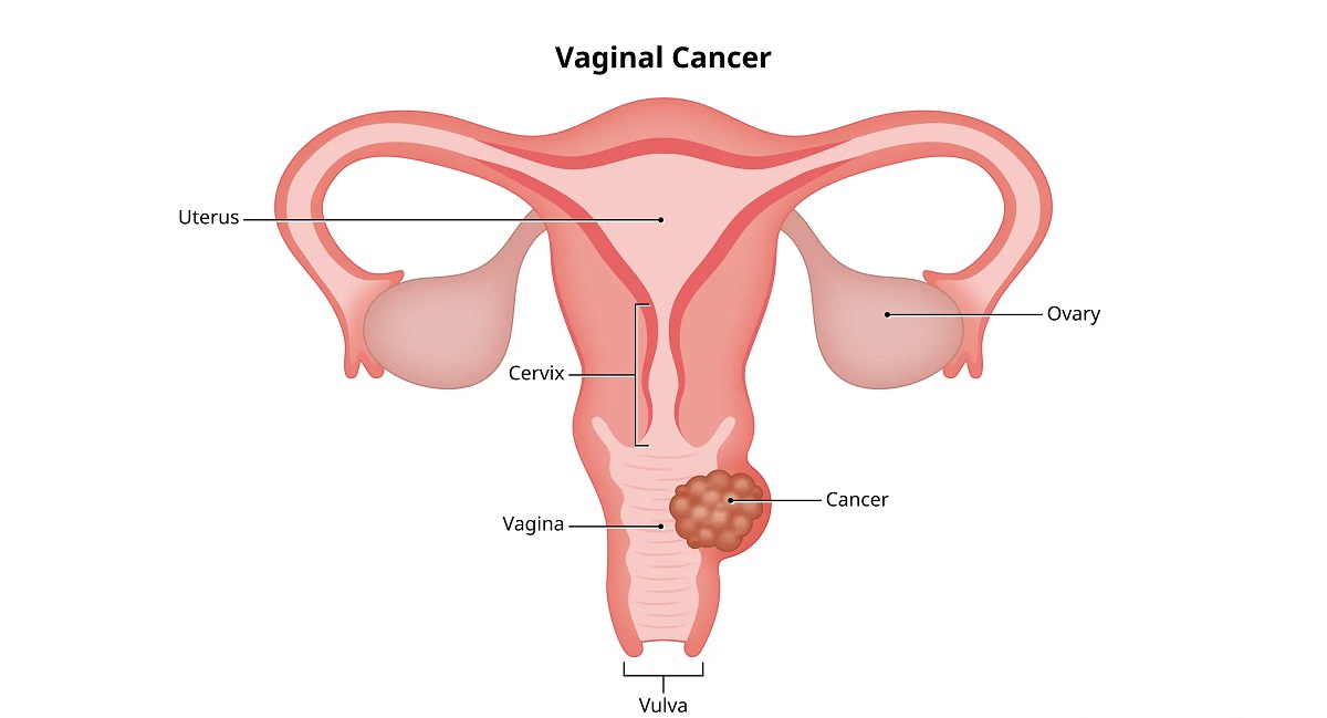 vaginal cancer.1