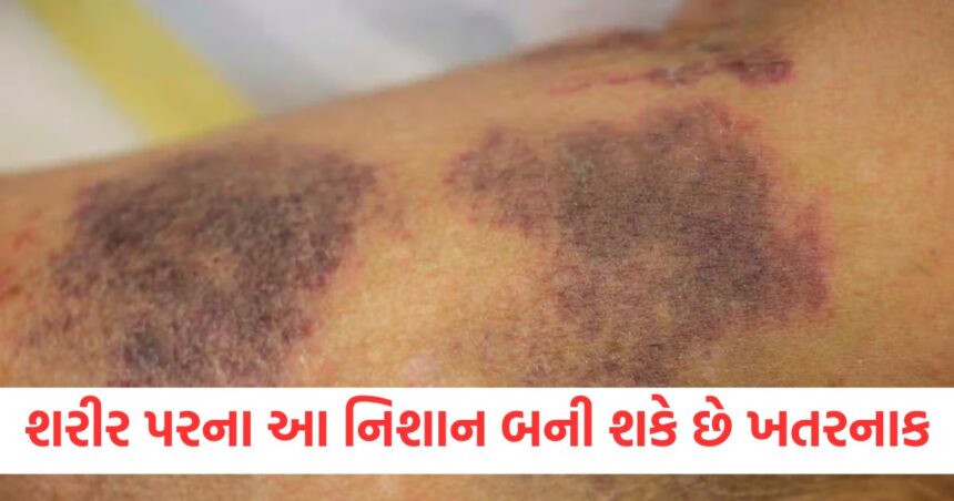 શરીર પર દેખાતા આ નિશાન બની શકે છે ખતરનાક, તે સૂચવે છે કોઈ ગંભીર બીમારી, તેને અવગણશો નહીં 1 attention these marks visible on the body can be dangerous serious disease do not ignore them1