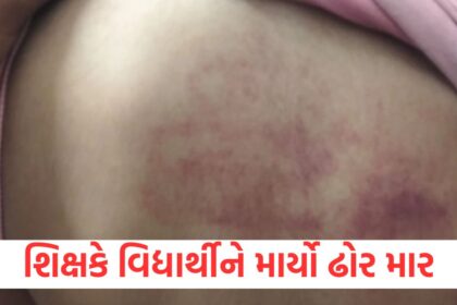 punishment or cruelty students back turned red due to teachers beating teacher suspended