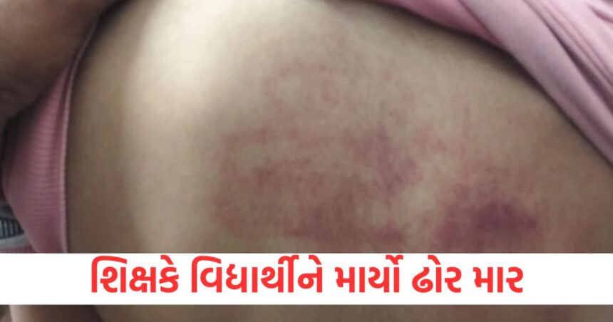 વિદ્યાર્થીને માર્યો શિક્ષકે ઢોર માર, છાત્રના પરિજનોએ શિક્ષક વિરુદ્ધ ઉઠાવી કાર્યવાહીની માંગ 1 punishment or cruelty students back turned red due to teachers beating teacher suspended
