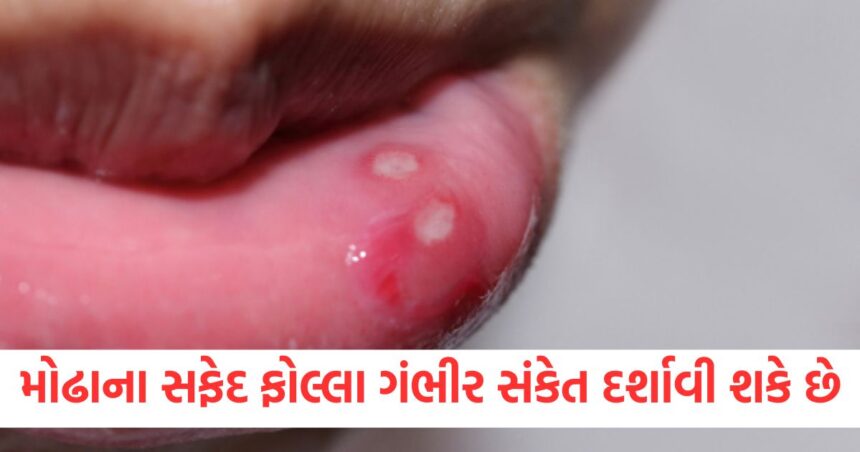 મોઢાના સફેદ ફોલ્લા આ ગંભીર સ્થિતિઓની નિશાની હોઈ શકે છે, ભૂલથી પણ તેમને અવગણશો નહીં 1 white blisters in the mouth can be a sign of these serious conditions1