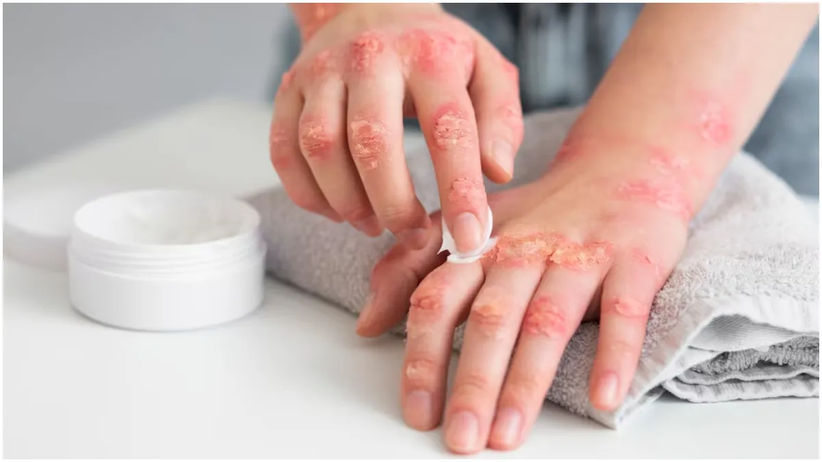 Which vitamin deficiency causes fungal i