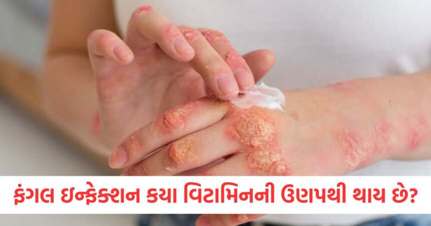 Which vitamin deficiency causes fungal infection