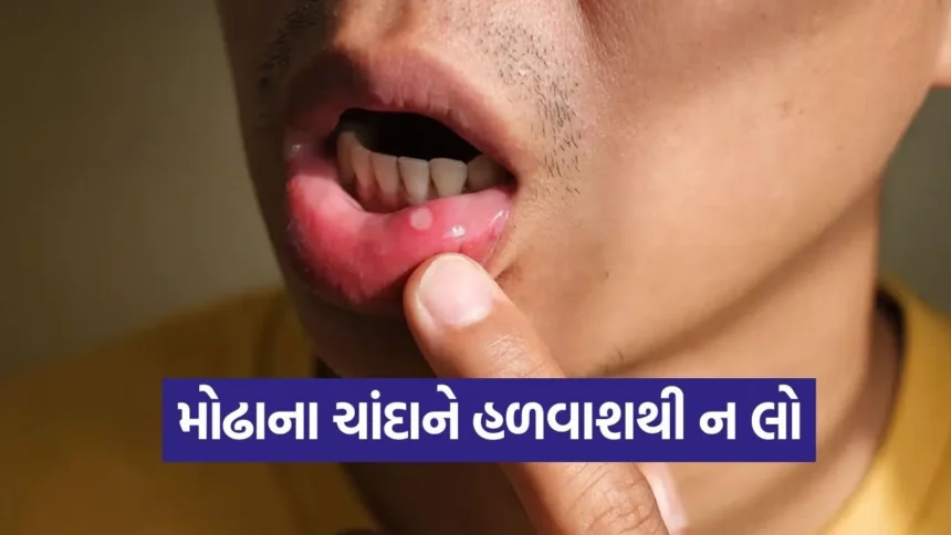 શું વારંવાર થતા મોઢાના ચાંદા ખતરનાક છે? જાણો આ બાબતે શું કહે છે હેલ્થ એક્સપર્ટ્સ 1 1768835200 dharmishtha 1 16.jpg.webp