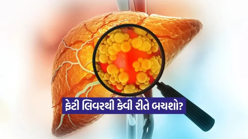 ભારત પર ‘ફેટી લિવર’નો મોટો ખતરો: લેન્સેટ રિપોર્ટ મુજબ દર 10 માંથી 4 ભારતીય આ બીમારીનો શિકાર 1 INDIA 1 95.jpg.webp