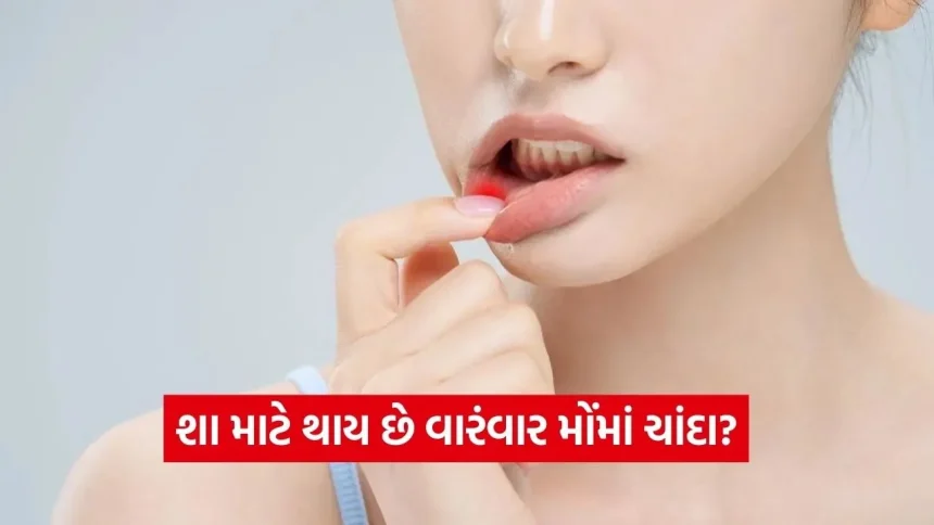 મોંમાં વારંવાર પડતા ચાંદાને હળવાશમાં ન લો! જાણો આ વિટામિનની કમી છે કે પેટની બીમારીના સંકેત 1 dharmishtha 1 9.jpg.webp