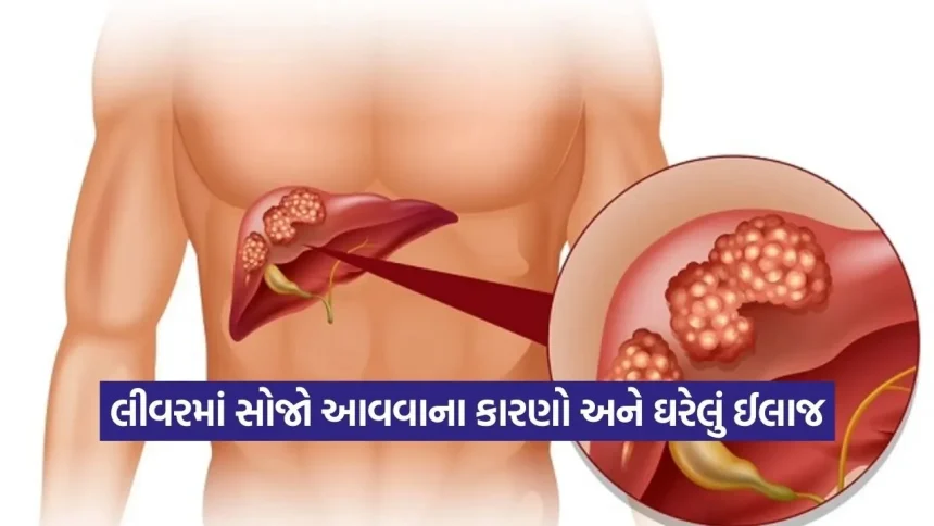 સાવધાન! તમારી આ ભૂલોના કારણે લીવરમાં આવી શકે છે સોજો, જાણો ફેટી લીવરના મુખ્ય કારણો 1 dharmishtha 1 2026 03 10T170000.116.jpg.webp