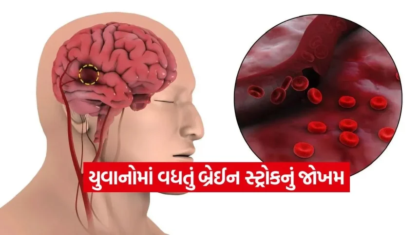 યુવાનોમાં વધતું બ્રેઈન સ્ટ્રોકનું જોખમ! 40 વર્ષથી નાની ઉંમરે કેમ આવે છે એટેક? ડોક્ટરોએ જણાવ્યા 3 મુખ્ય કારણો 1 sto ck.jpg.webp