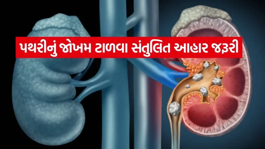 Kidney stone 3004.jpg.webp