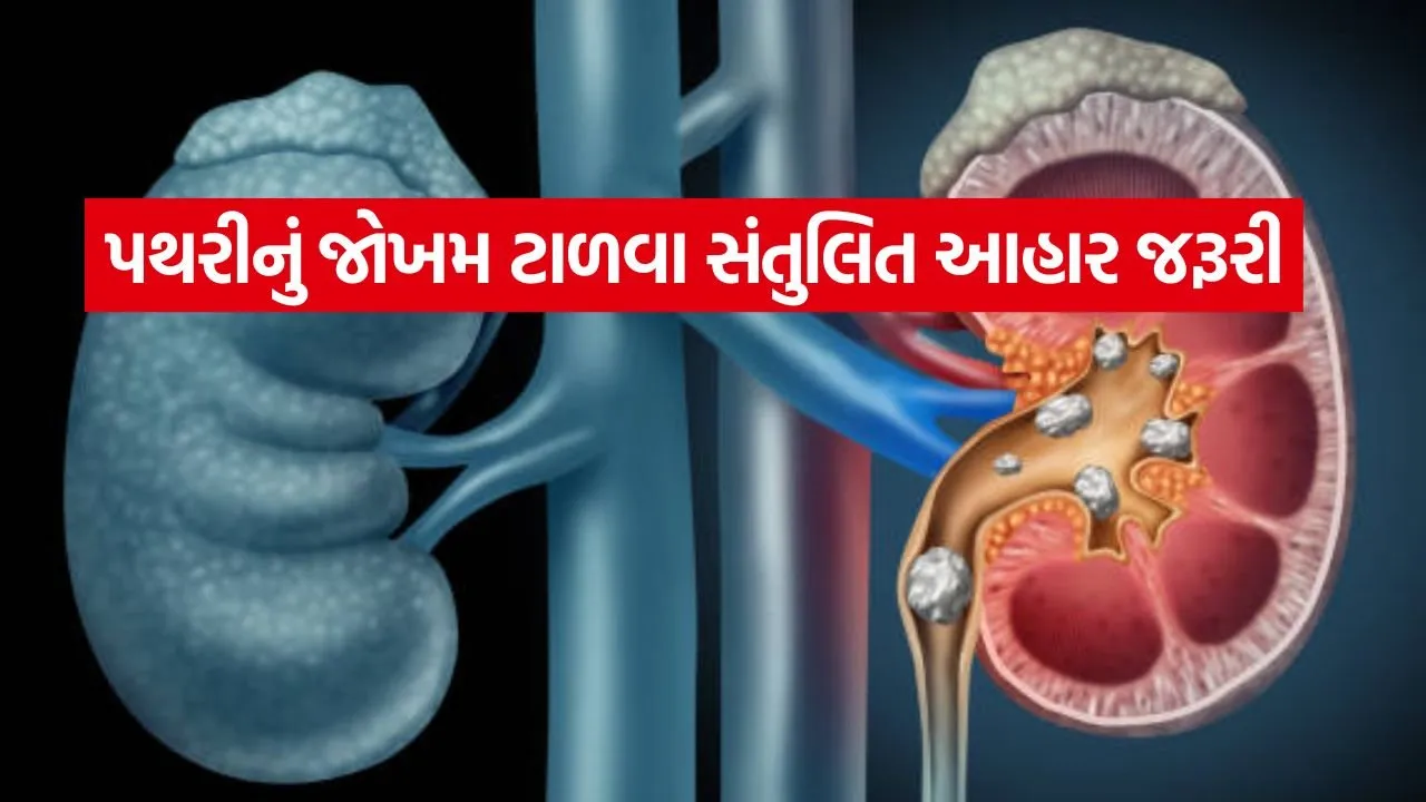 કિડનીમાં પથરીનું જોખમ વધારતી આ ૩ ઘાતક આદતો, સમય રહેતા ચેતી જવાની જરૂર