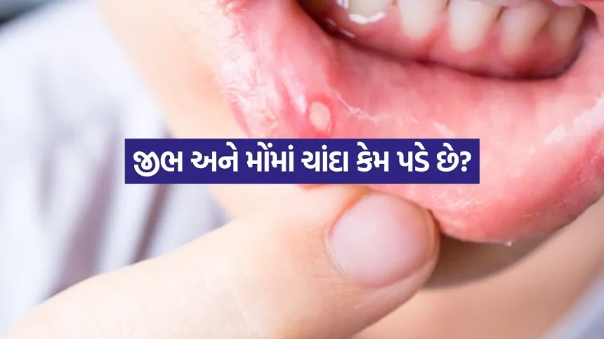 Mouth Ulcers 0608.jpg.webp