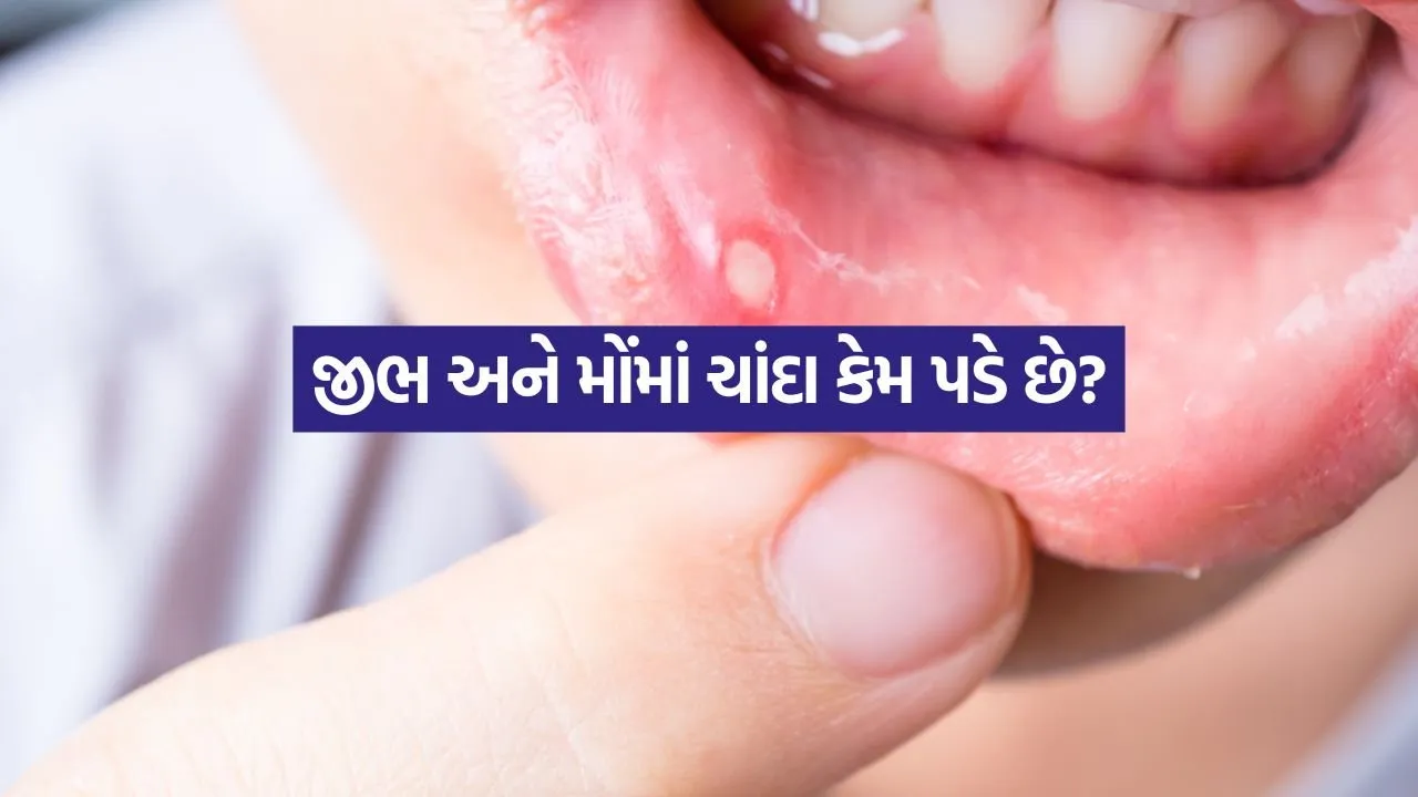 Mouth Ulcers 0608.jpg.webp