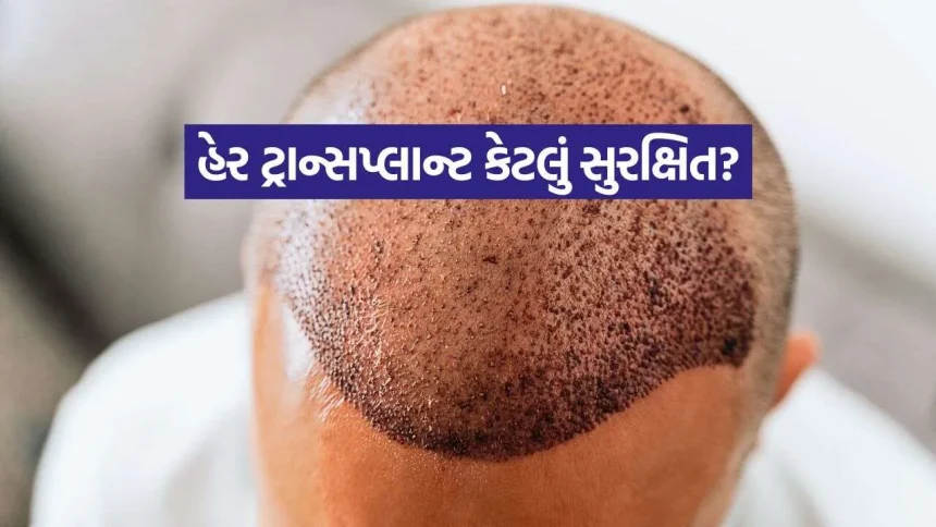 હેર ટ્રાન્સપ્લાન્ટ કરાવતા પહેલા જાણો આ મહત્વની વાતો, નહીં તો થઈ શકે છે નુકસાન 1 iNDIA 12.jpg.webp