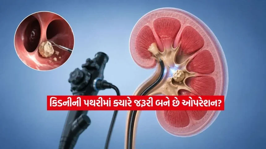કિડનીમાં 5 mm, 10 mm કે તેનાથી મોટી પથરી હોય તો શું કરવું? જાણો ક્યારે દવાથી થશે ઈલાજ અને ક્યારે સર્જરી જરૂરી 1 kidney1.jpg.webp